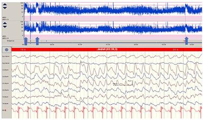 Neuromonitoring in Neonatal-Onset Epileptic Encephalopathies